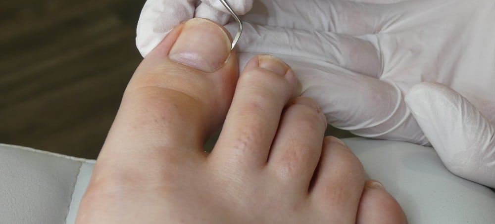 Treatment Options for Black Toenails at Richardson Podiatry