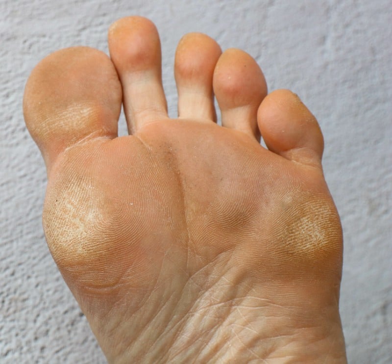 Plantar Warts Symptoms Causes And Treatment 54 OFF