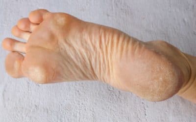 Everything to Know About Plantar Warts