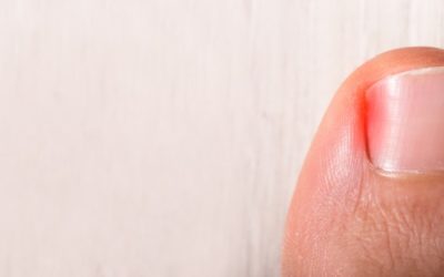 6 Options to Relieve Ingrown Toenail Pain at Home