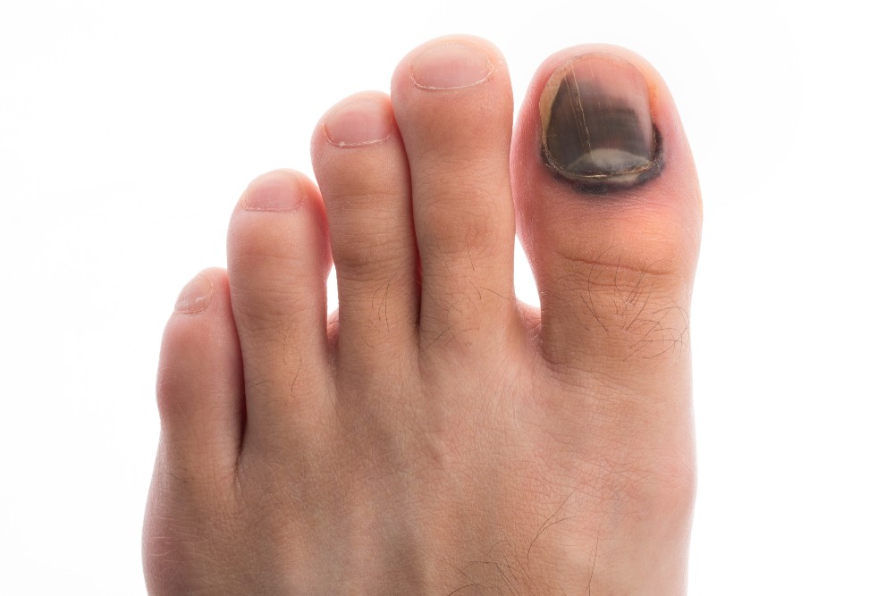 Foot needing to get black toenails evaluated