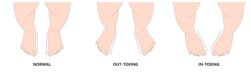 Showing normal feet verses in-toeing and out-toeing