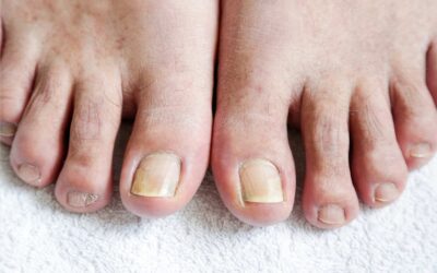 What Should I Do About Reoccurring Ingrown Toenails?