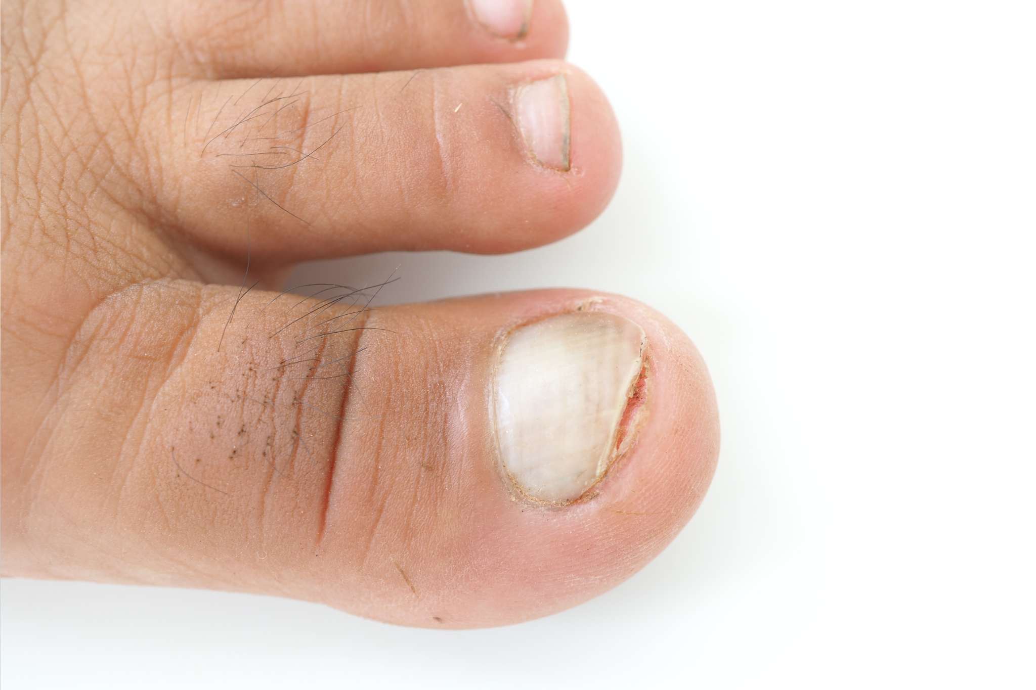 Crooked toenails with ingrown