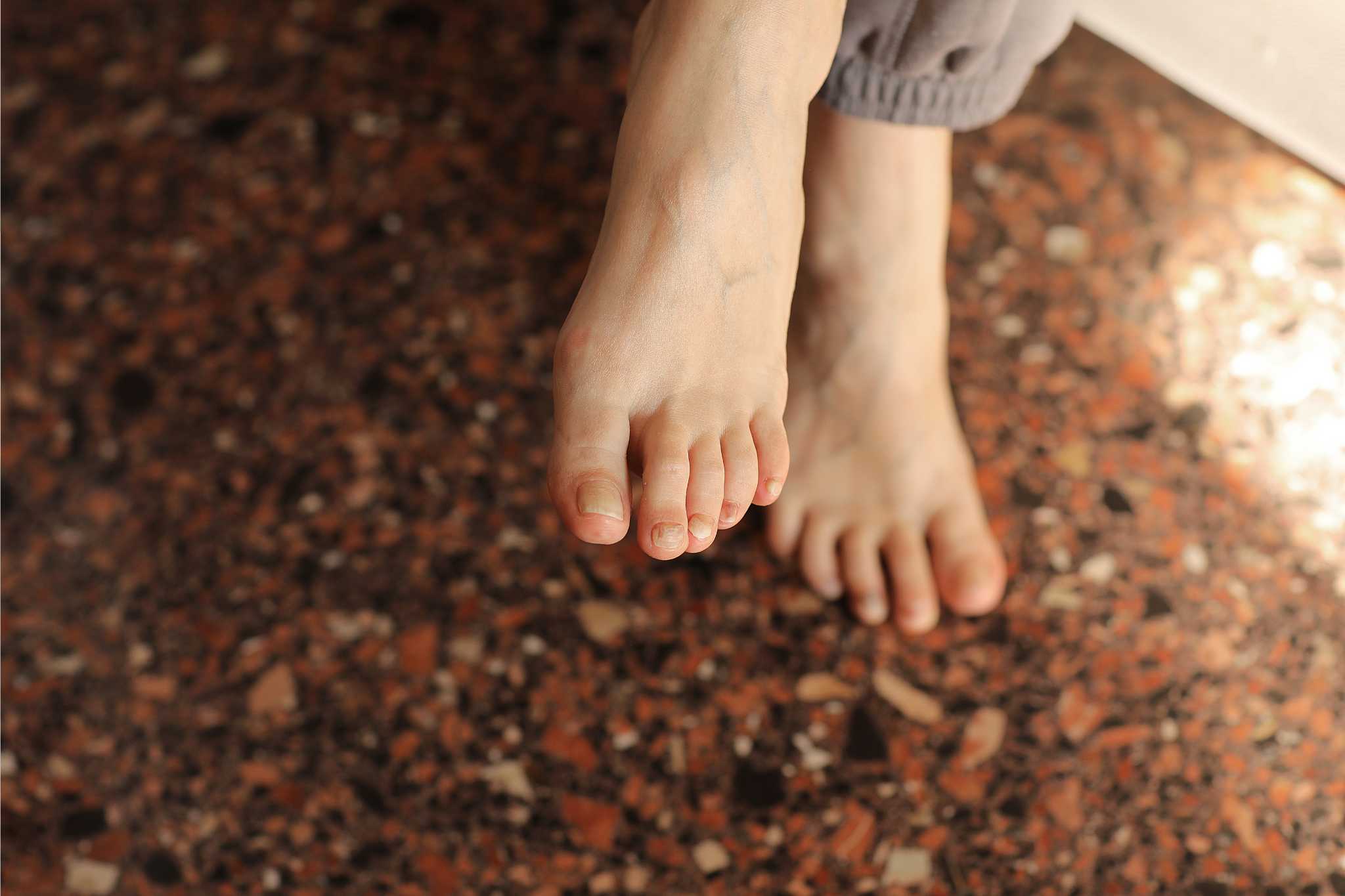 crossed leg with ingrown toenail