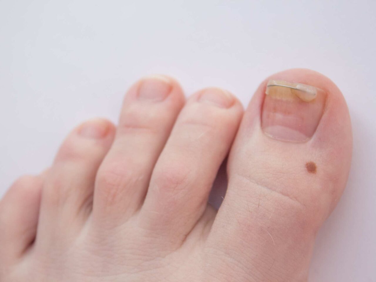 When Should You See a Doctor About Your Ingrown Toenails? Richardson Podiatry Center