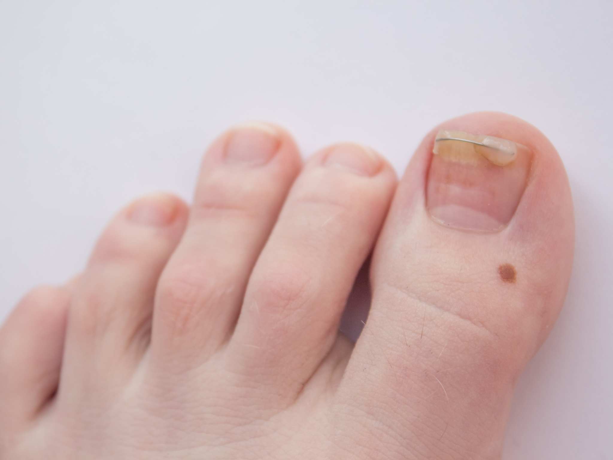 ingrown nail treatment. Hardware manicure. Concept body care.