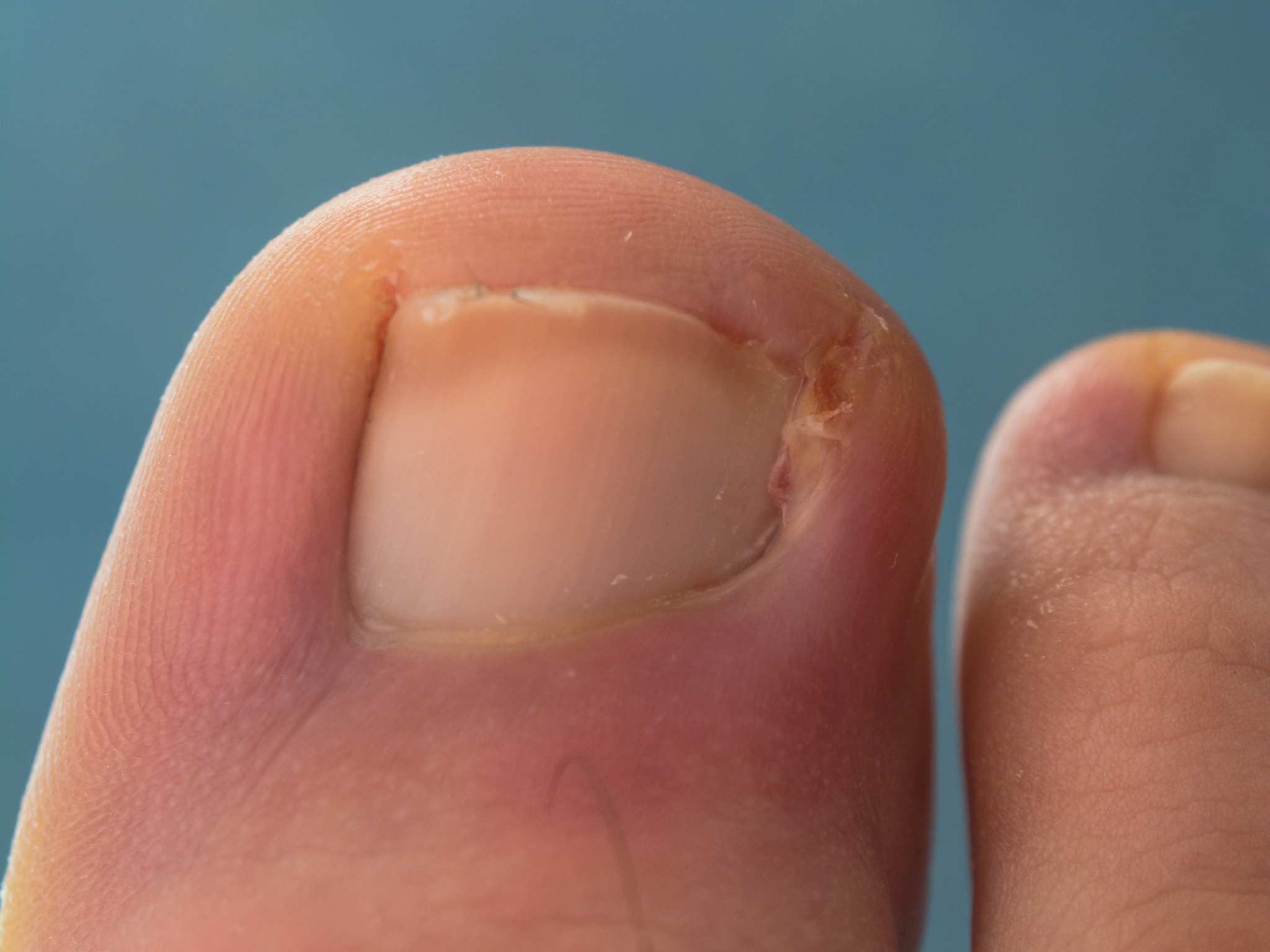 close-up photo of a toenail infection in human