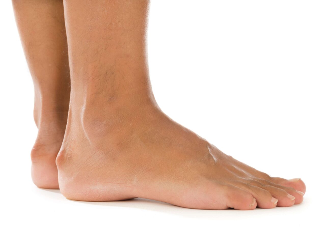 Haglund’s Deformity | Richardson Podiatry Center