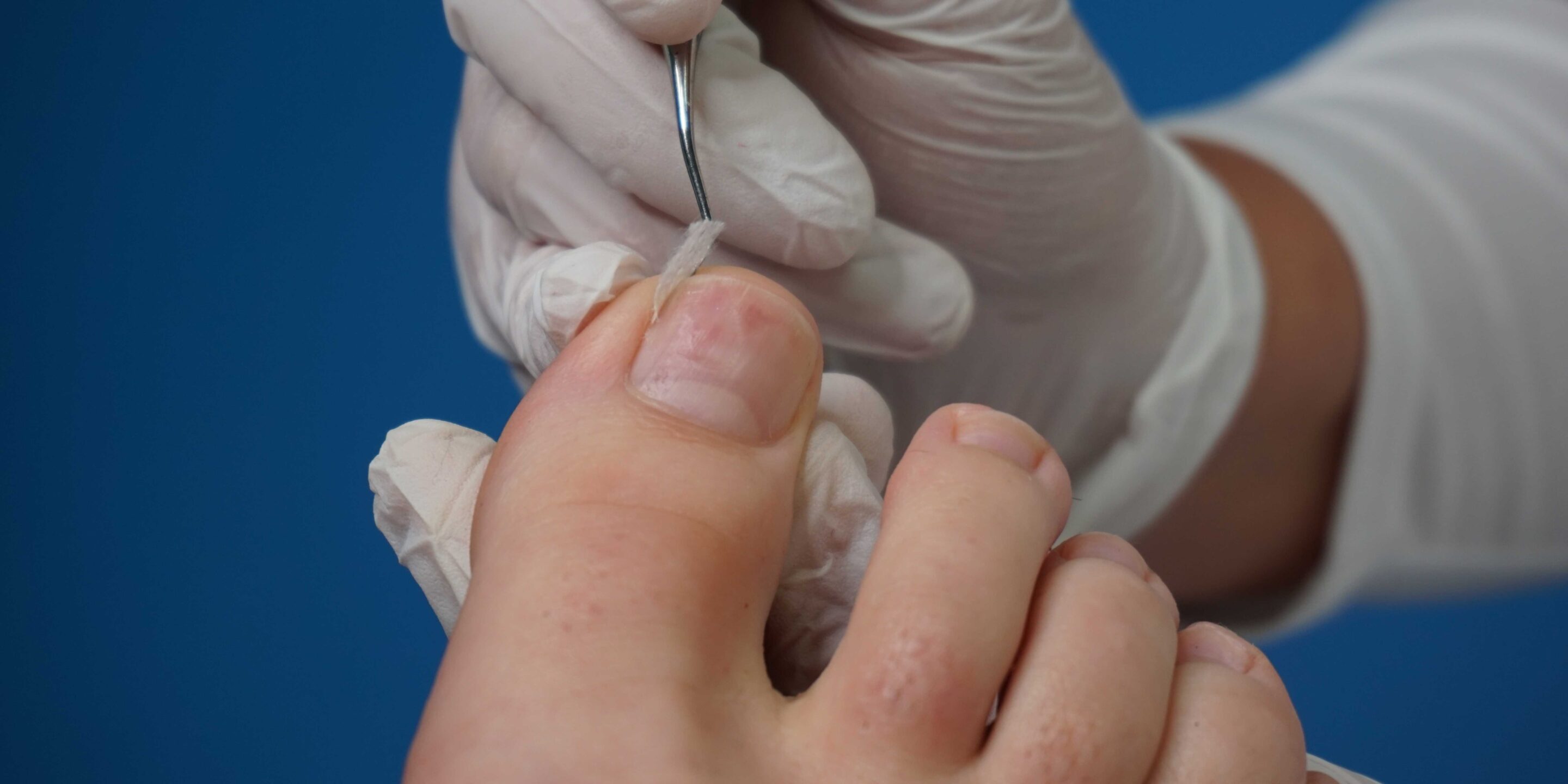 Podiatry, Chiropodist, medical foot care, podiatrist, ingrown toenail, fix an ingrown toenail