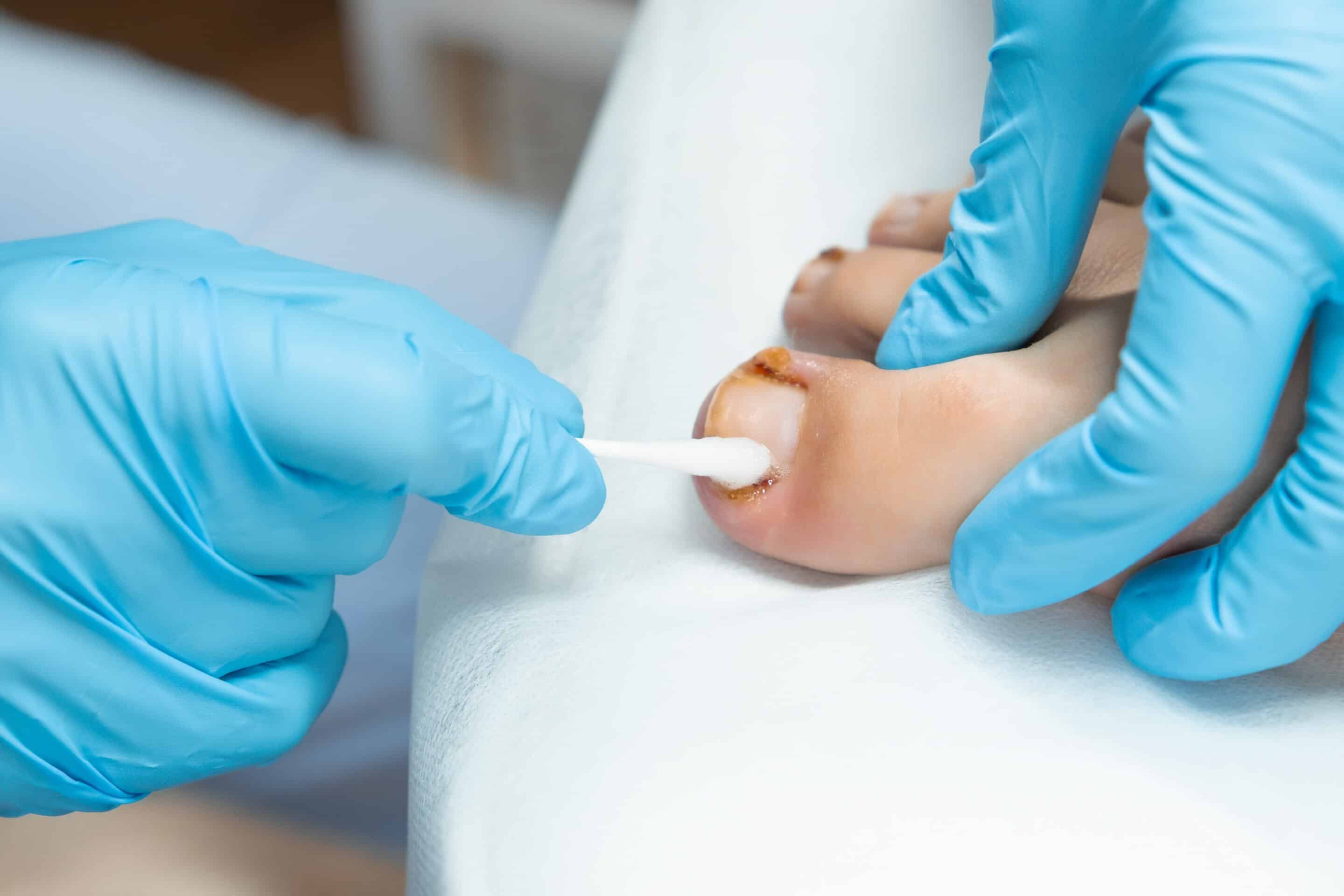 Treating swollen toe due to ingrown toenail