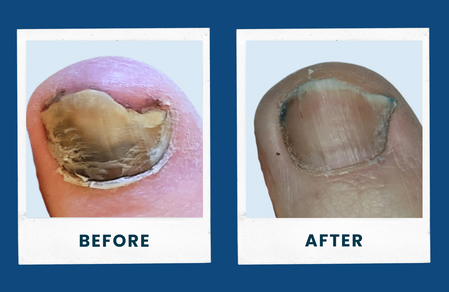 before after image for toenail fungus treatment